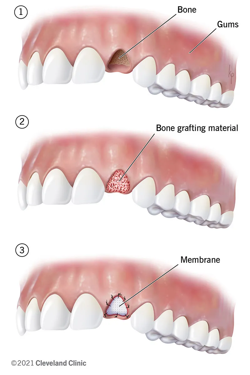 Illustration showing the steps of bone grafting in dental treatment