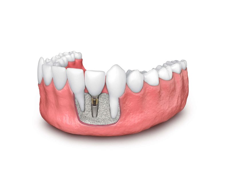 Illustration of a dental implant placed in the lower jaw with surrounding bone graft material.
