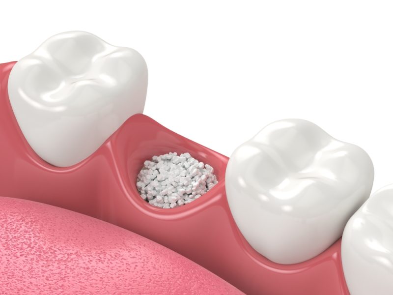 Illustration showing bone graft material placed in a dental socket to prepare for an implant